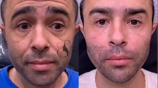 Motorista que atropelou Kayky Brito faz harmonização facial e vira influencer