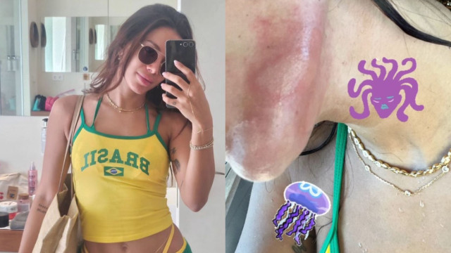 Anitta é queimada por água-viva em Ibiza