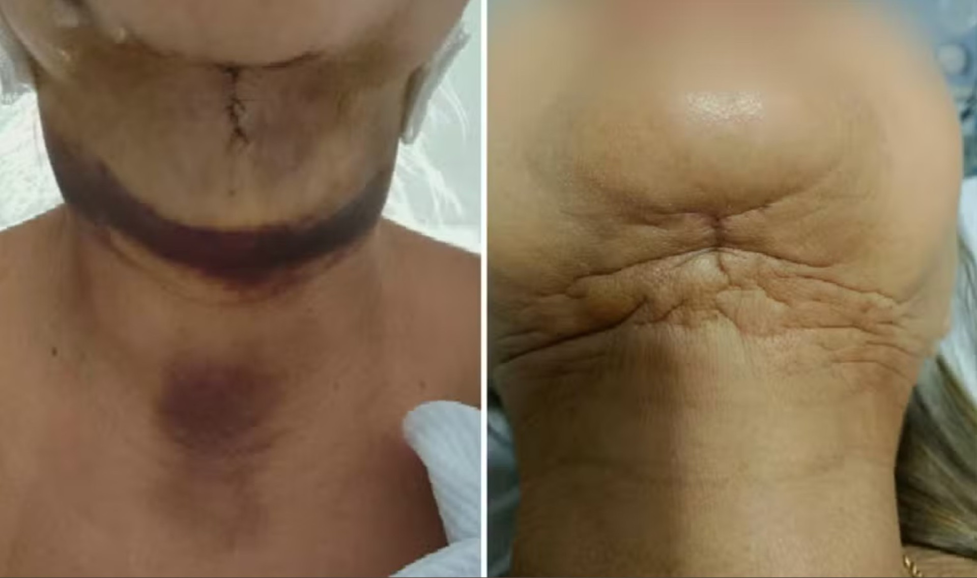 Influencers suspeitos de deformar pacientes diluíam medicamento por lucro