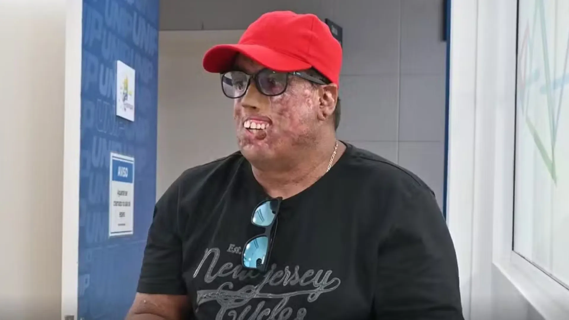 Homem com doença rara passa por 230 cirurgias no rosto e ganha prótese