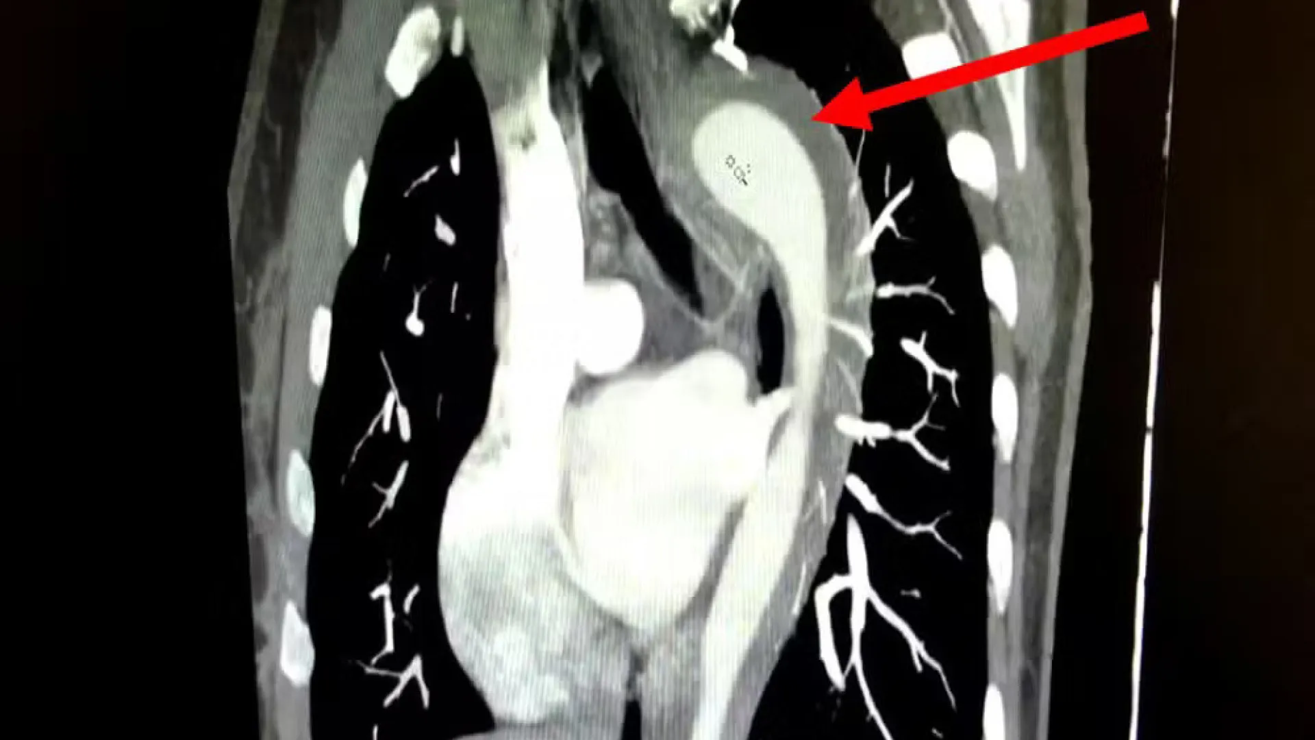Mulher de 45 anos rompe aorta durante orgasmo e passa por cirurgia