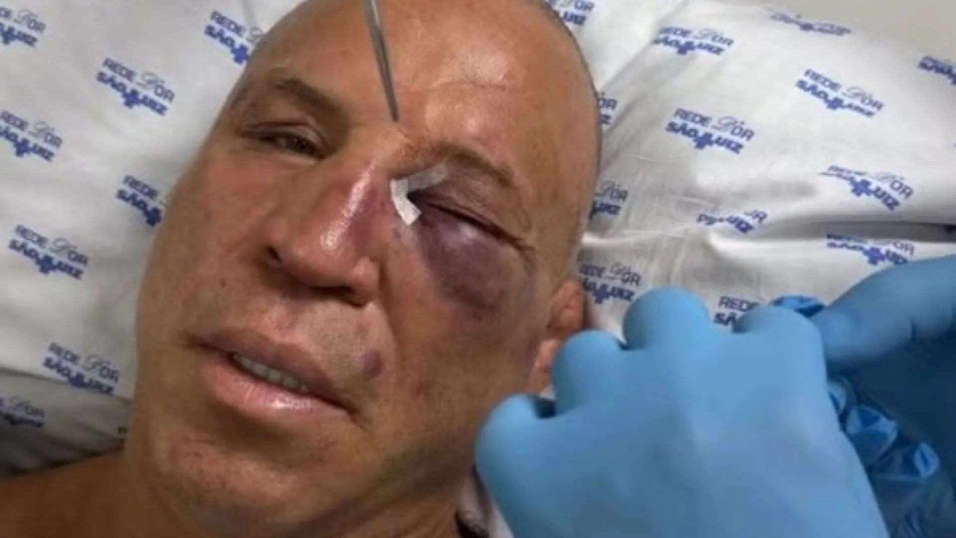 Wanderlei reclama de dores de cabeça e diz: ‘magoado por dentro e por fora’