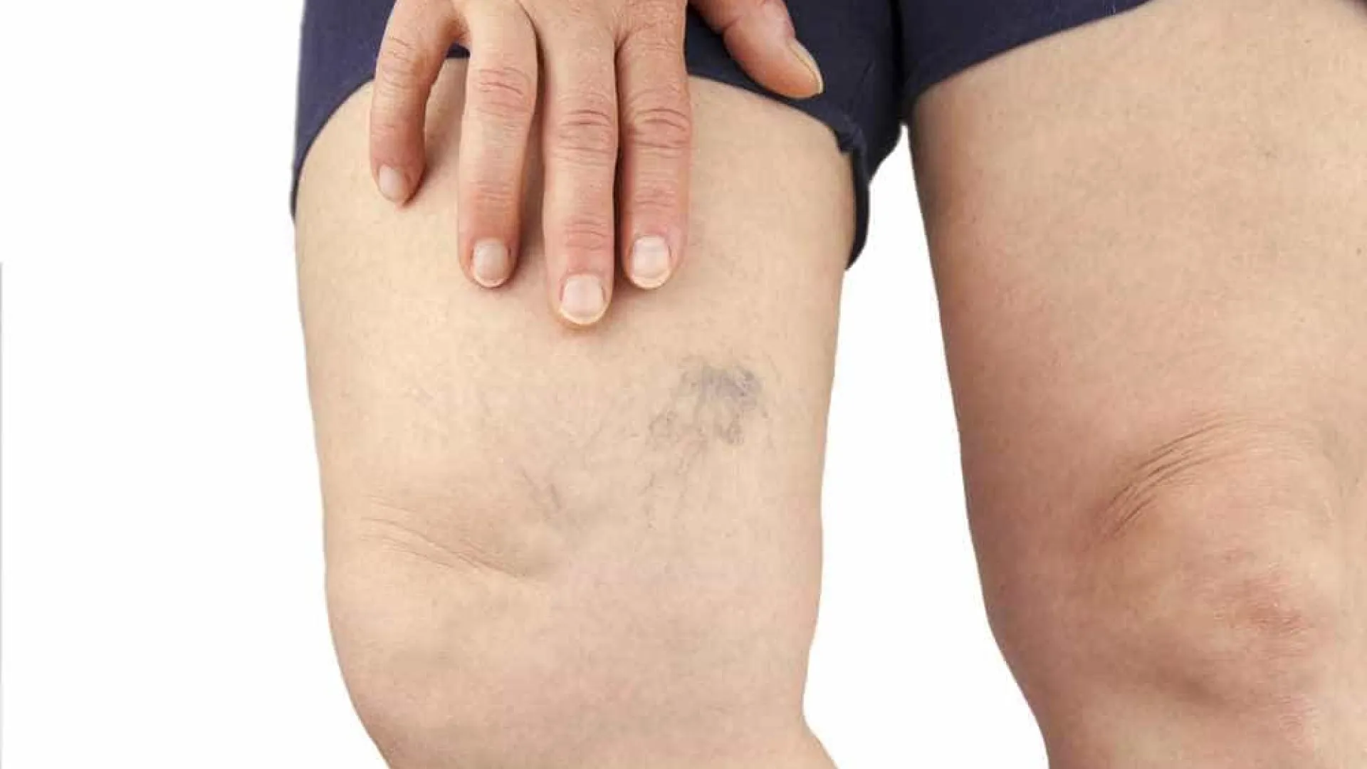 Sofre com varizes? Conheça mitos e verdades sobre a doença